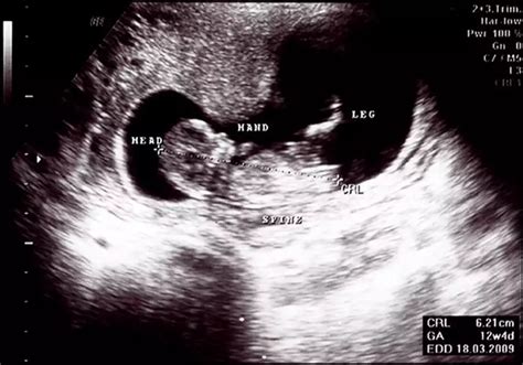 hamilelikte ultrason terimleri